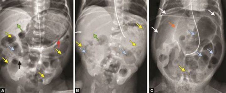 Can a baby die from necrotizing enterocolitis
