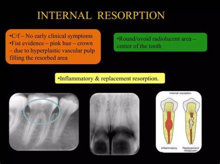 Can a tooth with internal resorption be saved