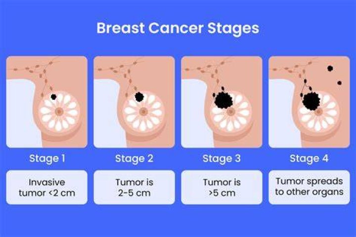 How common is breast cancer in tail of Spence