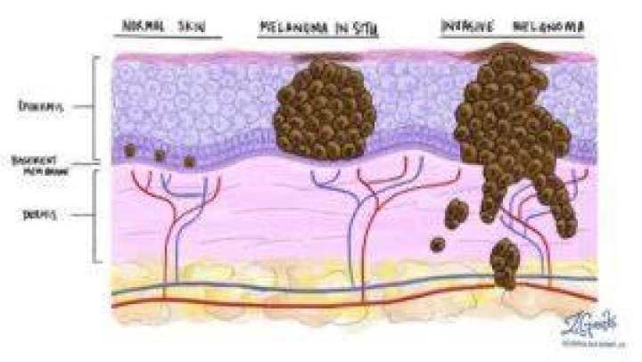 How fast does lentigo maligna melanoma spread