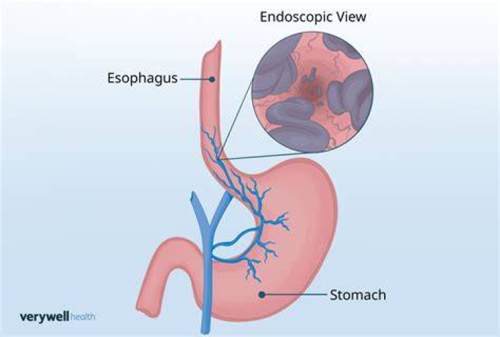 How long can you live with esophageal varices