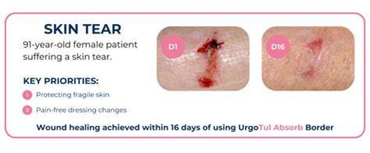 How long does it take for a skin tear to heal