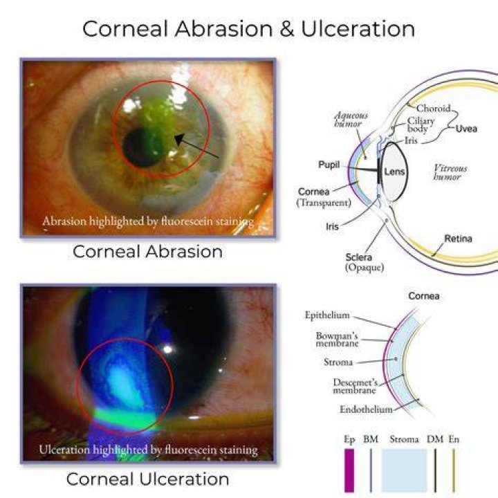 Is corneal ulcer the same as corneal abrasion