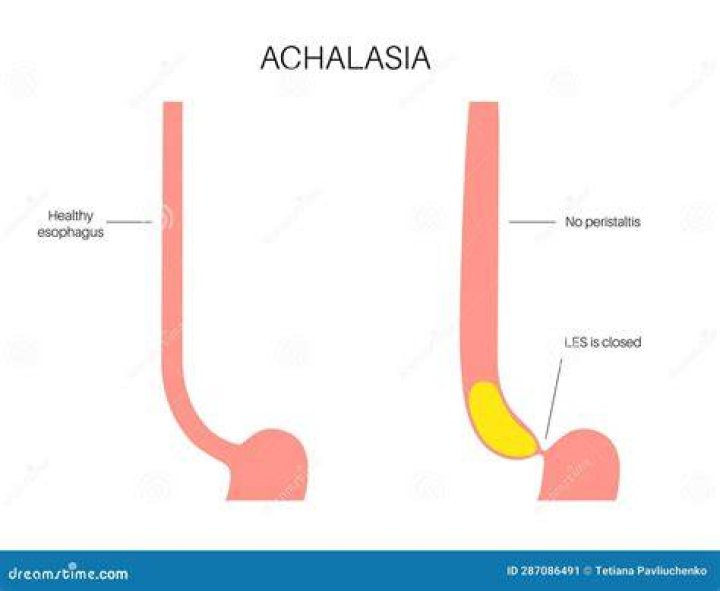 Is esophageal achalasia an autoimmune disease