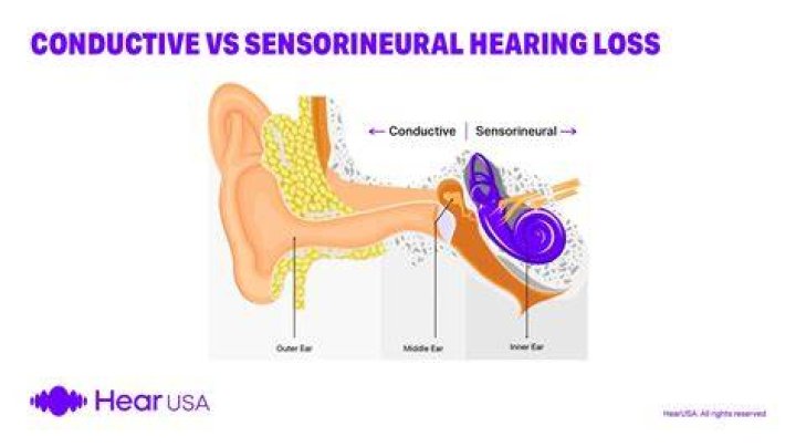 Is presbycusis and sensorineural hearing loss