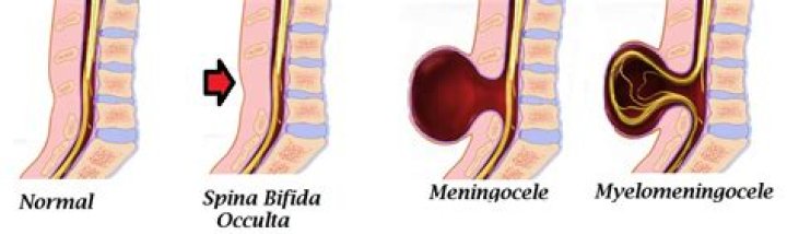 Is spina bifida and myelomeningocele the same