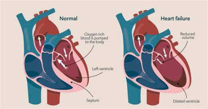 What are the causes of systolic heart failure