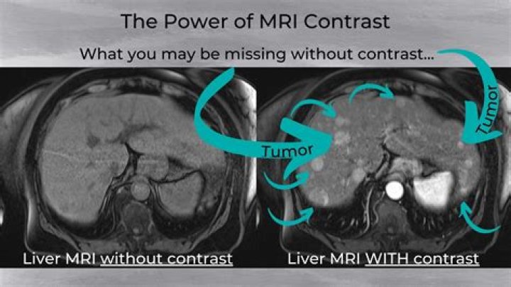 What are the side effects of MRI contrast dye