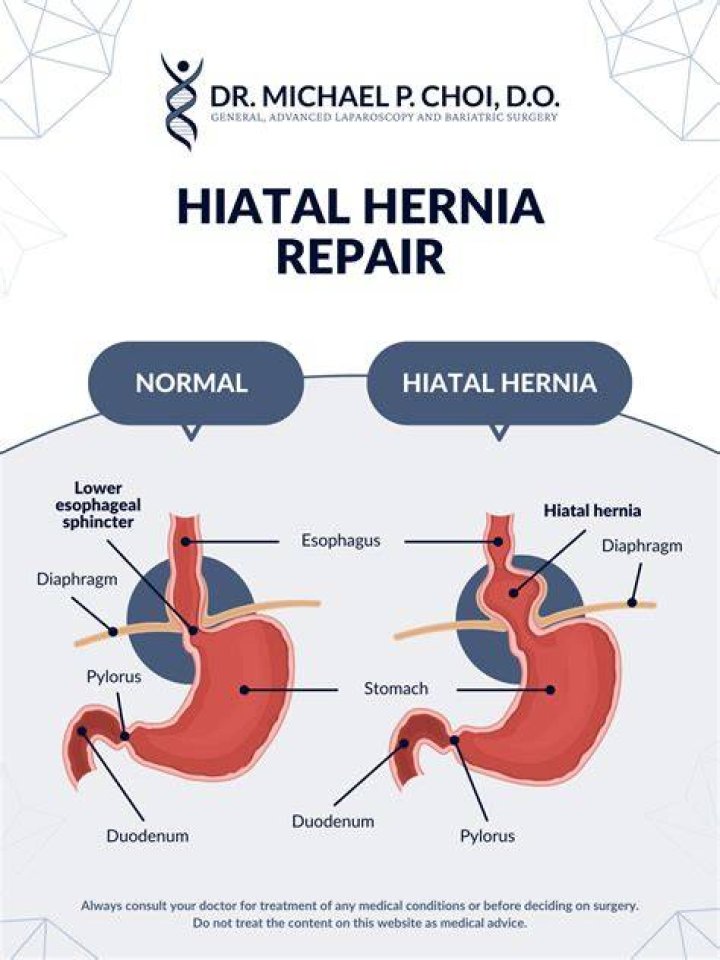 What can I expect after hiatal hernia surgery