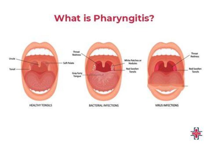 What happens if pharyngitis is left untreated