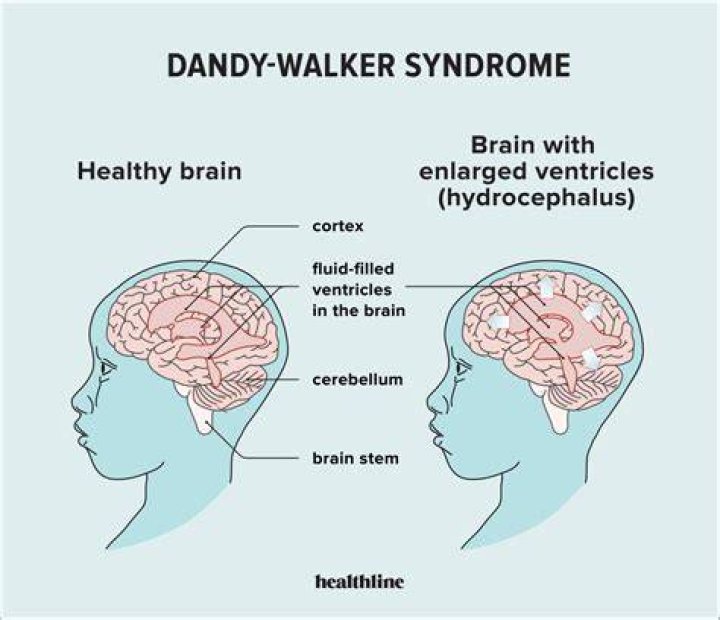 What is Dandy Walker syndrome associated with