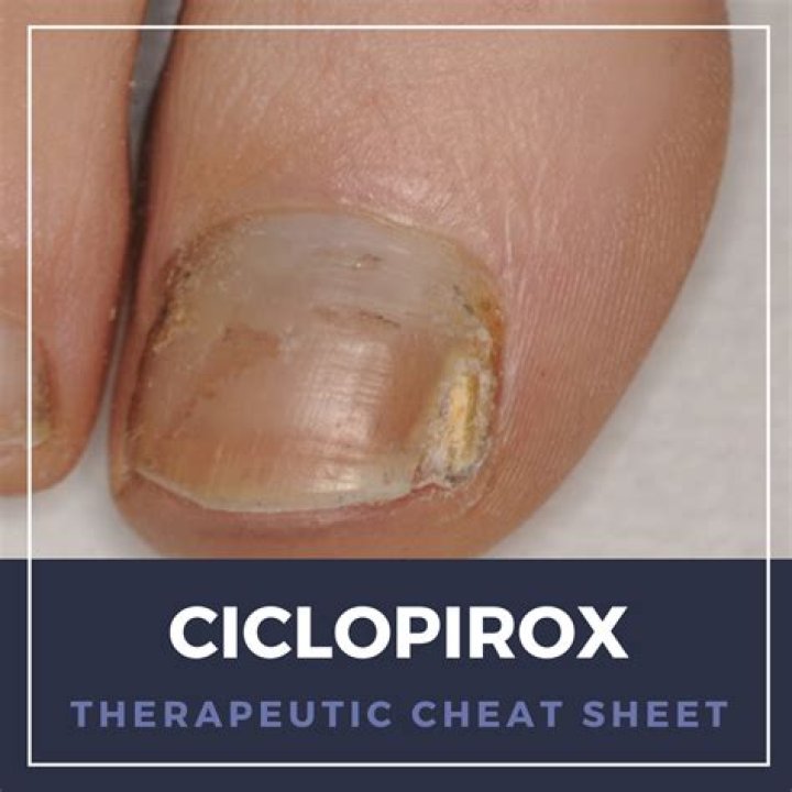 When is the best time to apply ciclopirox