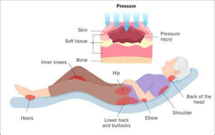 Why bony prominences are liable for bed sores